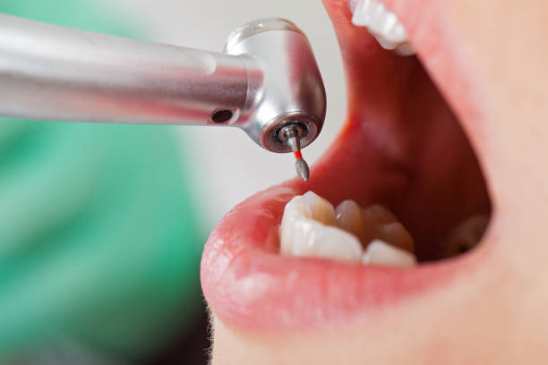Best Chipped Tooth Repair Near Me  in Wesley Chapel, NC